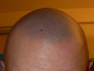 bald head